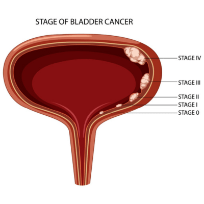 Urological Cancer treatment with Dr. Nitin Singhal, India’s leading uro-oncologist