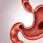 Medical illustration of human stomach showing cancer or ulcer growth inside the stomach lining.-Best Gastro Cancer Surgeon
